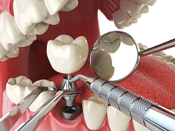 Best Emergency Dental Extractions in Wakefield, VA